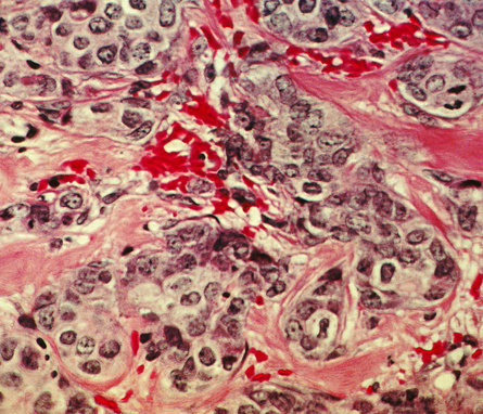 Microscopy image of human breast cancer tissue showing tumor cells in purple and connective tissue in pink