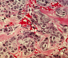 Microscopy image of human breast cancer tissue showing tumor cells in purple and connective tissue in pink