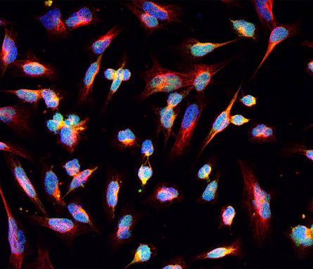 Microscopy image shows glioma tumor cells in blue and pink.