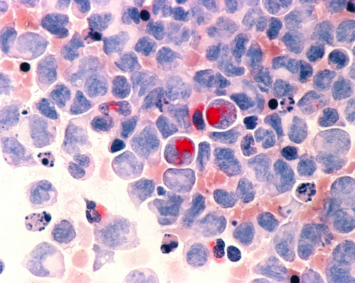 A microscope image of cells from acute myeloid leukemia, a kind of cancer. The cancer cells are stained red.