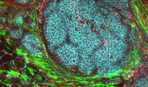 Microscopic view of a breast cancer tumor in a mouse model, with dense clusters of irregular cancer cells stained blue.