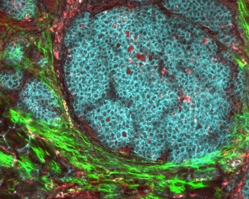 Microscopic view of a breast cancer tumor in a mouse model, with dense clusters of irregular cancer cells stained blue.