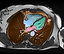 MRI scan of the heart shows the left ventricle (green), which researchers studied to look for genetic markers for conditions that lead to heart failure.