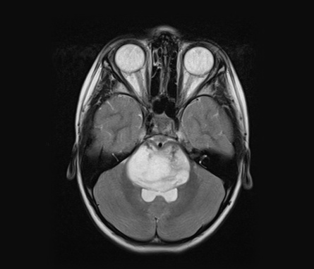 MRI of a diffuse midline glioma