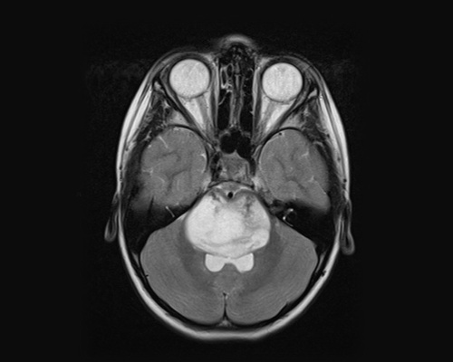 MRI of a diffuse midline glioma