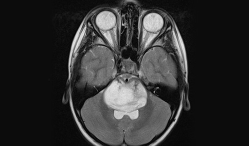 MRI of a diffuse midline glioma