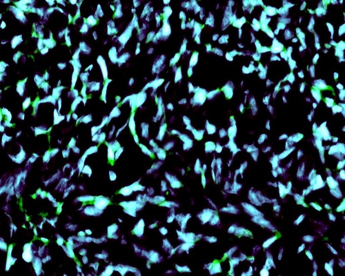 Glioma cells. (Credit: <a href=details6862.html target="_blank">National Cancer Institute / Henry Ford Hospital</a>)