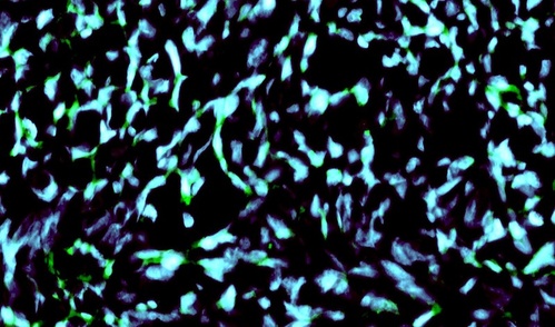 Glioma cells. (Credit: <a href=details6862-2.html target="_blank">National Cancer Institute / Henry Ford Hospital</a>)