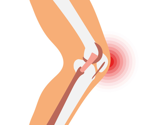 Cartoon illustration of a knee with red concentric circles denoting pain from arthritis