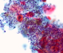 Lung squamous cell carcinoma cells (Credit: <a href=efq3fp_.html target="_blank">Ed Uthman/Flickr</a>)