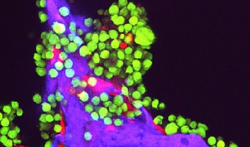 A fluorescent microscope image of multiple myeloma cancer cells glowing green and bone cells glowing red on a scaffold made of silk protein glowing purple.