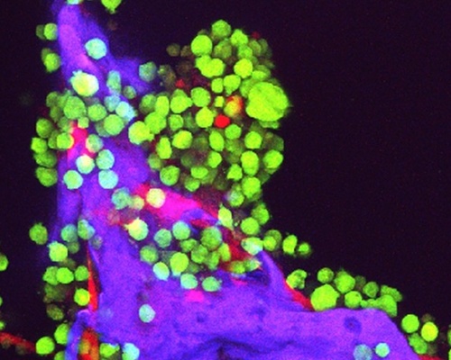 A fluorescent microscope image of multiple myeloma cancer cells glowing green and bone cells glowing red on a scaffold made of silk protein glowing purple.