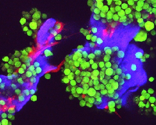 A fluorescent microscopy image showing multiple myeloma cells colored green and bone cells colored red, growing on an artificial scaffold colored purple,