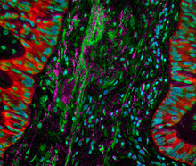 Lung cancer cells (Credit: NCI)