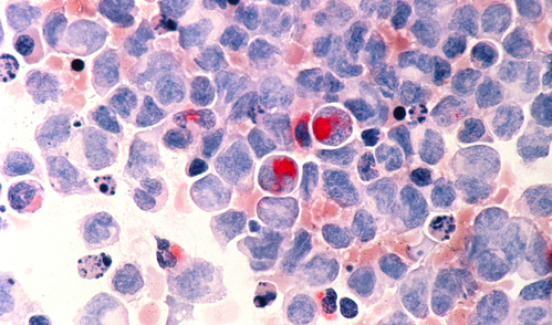 Human cells with acute myelocytic leukemia (AML) in the pericardial fluid.