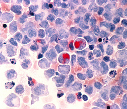 Human cells with acute myelocytic leukemia (AML) in the pericardial fluid.