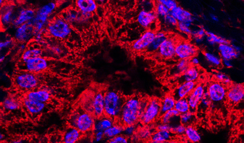 Pancreatic cancer cells