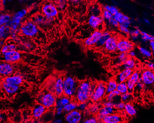 Pancreatic cancer cells