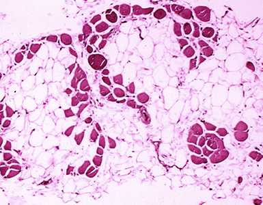 Microscopic image of cross-sectional calf muscle from a person with Duchenne muscular dystrophy, showing extensive replacement of muscle fibers by fat cells