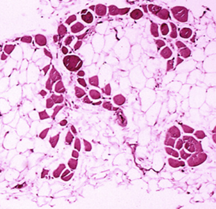 Microscopic image of cross-sectional calf muscle from a person with Duchenne muscular dystrophy, showing extensive replacement of muscle fibers by fat cells
