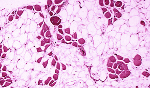 Microscopic image of cross-sectional calf muscle from a person with Duchenne muscular dystrophy, showing extensive replacement of muscle fibers by fat cells