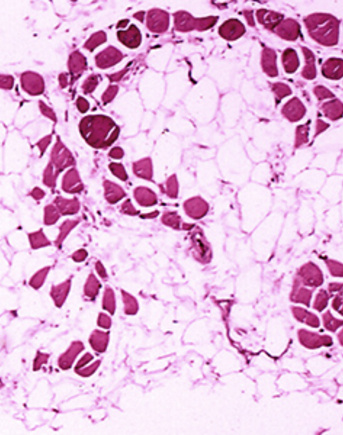 Microscopic image of cross-sectional calf muscle from a person with Duchenne muscular dystrophy, showing extensive replacement of muscle fibers by fat cells