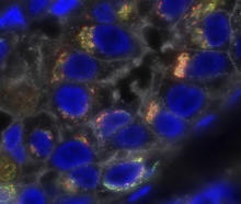 Triple-negative breast cancer cells (blue). (Credit: <a href=detailsfde3.html target="_blank">NCI</a>)
