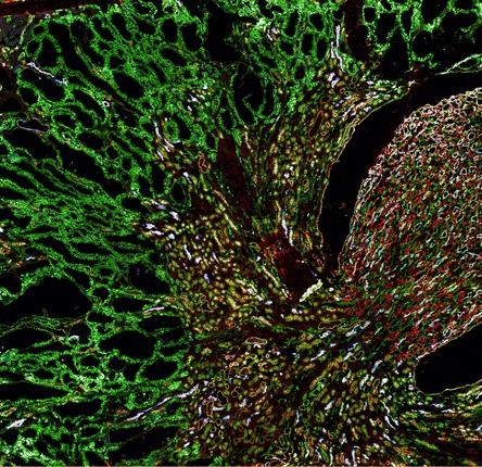 Misfolded MUC1-fs protein (green) builds up in the kidneys of a mouse model of MUC1 kidney disease. 