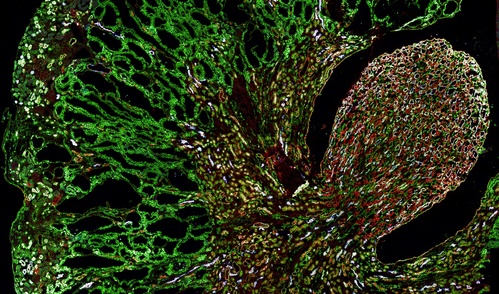 Misfolded MUC1-fs protein (green) builds up in the kidneys of a mouse model of MUC1 kidney disease. 