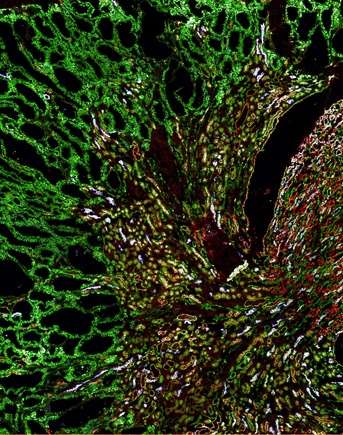 Misfolded MUC1-fs protein (green) builds up in the kidneys of a mouse model of MUC1 kidney disease. 