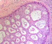 A histopathology image of ductal carcinoma in situ (DCIS) of the breast. The image shows a section of breast tissue stained with hematoxylin and eosin, revealing clusters of abnormal cells within the milk ducts. The ducts are filled with atypical cells exhibiting a cribriform pattern, characterized by round to oval spaces within the neoplastic cell clusters. The surrounding tissue appears dense and fibrous.
