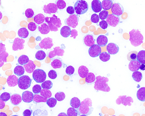 Acute lymphoblastic leukemia cells, stained pink-purple