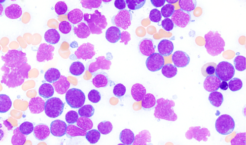 Acute lymphoblastic leukemia cells, stained pink-purple