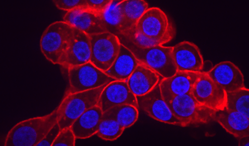 Ovarian cancer cells overexpress high levels of the phosphate importer protein SLC34A2 (red) which pumps phosphate into a cell and leaves it vulnerable to inhibiting phosphate export. Cell nuclei are shown in blue.