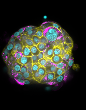 An intact pancreatic islet treated with interferon alpha and gamma, and stained for HLA-1 (yellow), proinsulin (magenta), nuclei (cyan).