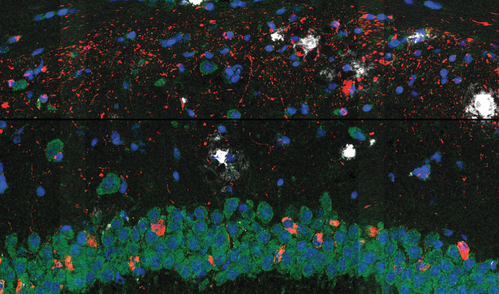 Fluorescence microscopy image of brain tissue from a mouse model of Alzheimer’s, showing tau tangles (red), amyloid plaques (white), RNA (green), and cell nuclei (blue).