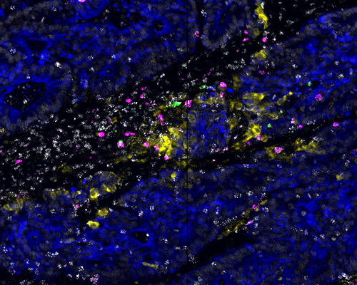  In a subset of human colorectal tumors, immune cells such as activated and potentially tumor-reactive T cells (white, green, and magenta) are organized into “hubs” around malignant cells (blue) expressing molecules (yellow) that attract immune cells.