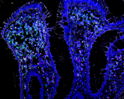 A snapshot of T cells expressing <i>CD4</i> (green), <i>CD8</i> (white), and <i>IL-17</i> (red) in inflamed colon tissue.
